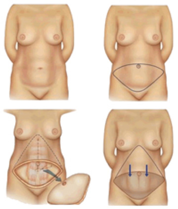 Cirurgia Plástica Abdominoplastia